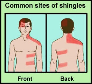 shingles